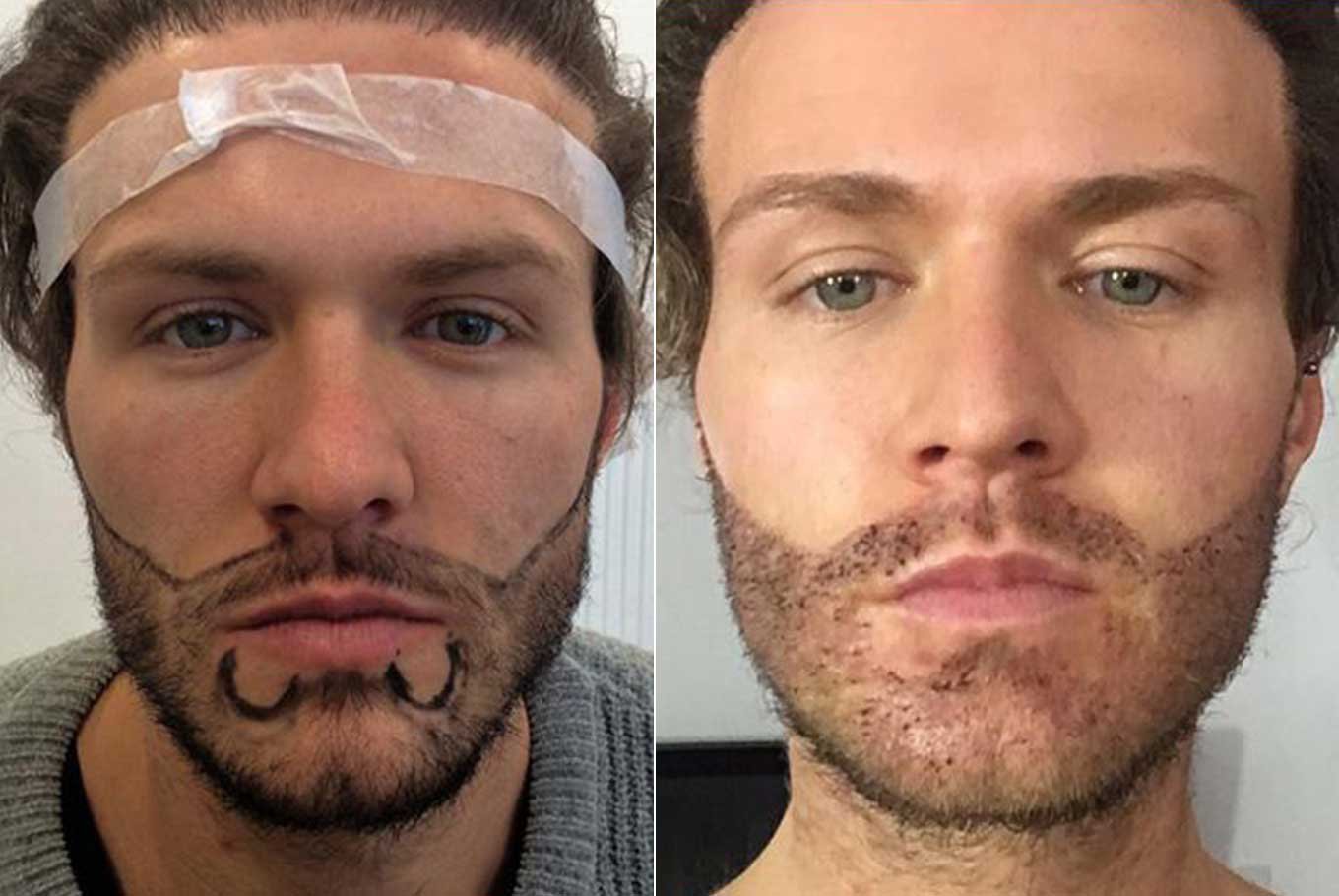 Beard Restoration Micro-FUE Procedure
